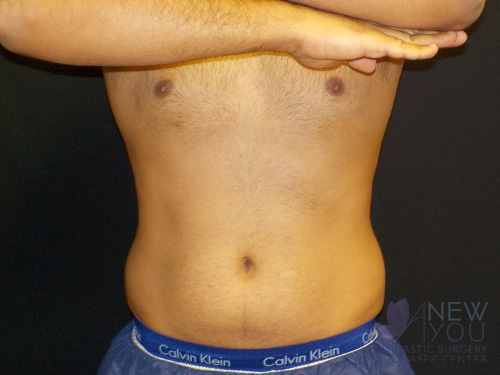 CoolSculpting® Before - Chicago, IL