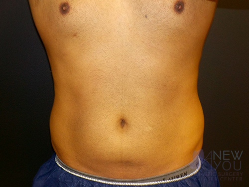 CoolSculpting® After - Chicago, IL