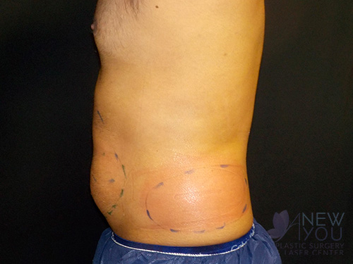 CoolSculpting® Before - Chicago, IL