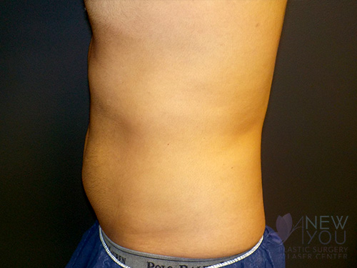 CoolSculpting® After - Chicago, IL