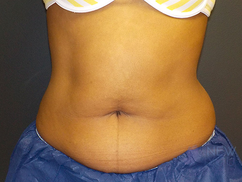 CoolSculpting® Before - Chicago, IL