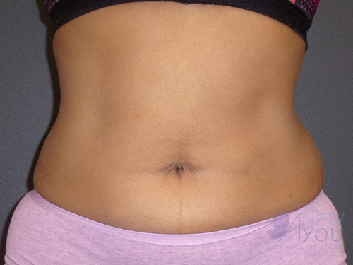 CoolSculpting® After - Chicago, IL