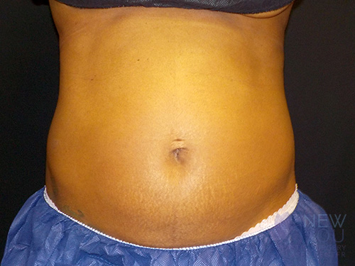 CoolSculpting® Before - Chicago, IL