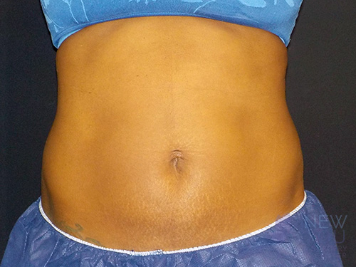 CoolSculpting® After - Chicago, IL