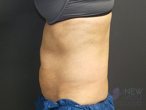 CoolSculpting® Before - Chicago, IL