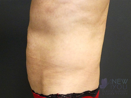 CoolSculpting® After - Chicago, IL