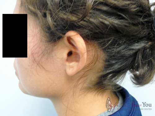 Ear Reshaping (Otoplasty) Before - Chicago, IL