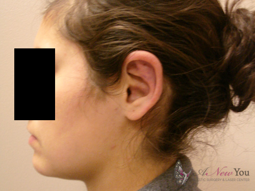 Ear Reshaping (Otoplasty) After - Chicago, IL