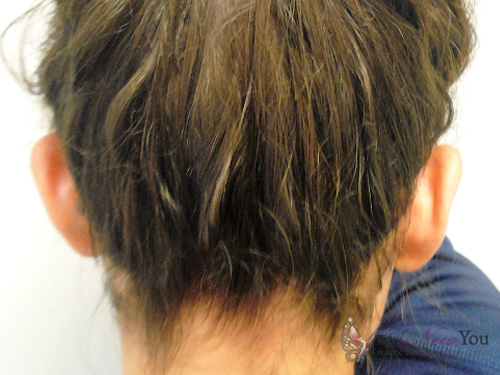 Ear Reshaping (Otoplasty) Before Ear Reshaping (Otoplasty) Before - Chicago, IL