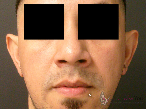 Ear Reshaping (Otoplasty) Before - Chicago, IL