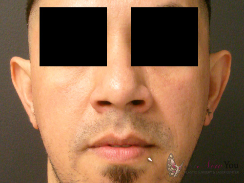 Ear Reshaping (Otoplasty) Before Ear Reshaping (Otoplasty) Before - Chicago, IL