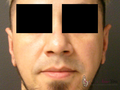 Ear Reshaping (Otoplasty) After Ear Reshaping (Otoplasty) After - Chicago, IL