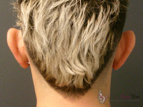 Ear Reshaping (Otoplasty) Before Ear Reshaping (Otoplasty) Before - Chicago, IL