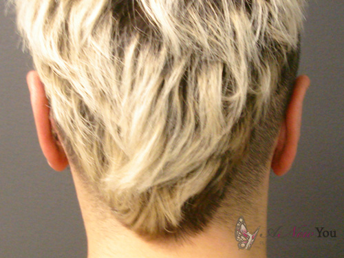 Ear Reshaping (Otoplasty) After Ear Reshaping (Otoplasty) After - Chicago, IL