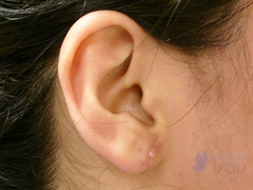 Ear Reshaping (Otoplasty) After - Chicago, IL