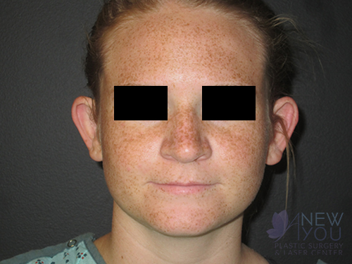 Ear Reshaping (Otoplasty) Before Ear Reshaping (Otoplasty) Before - Chicago, IL