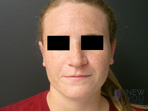 Ear Reshaping (Otoplasty) After Ear Reshaping (Otoplasty) After - Chicago, IL