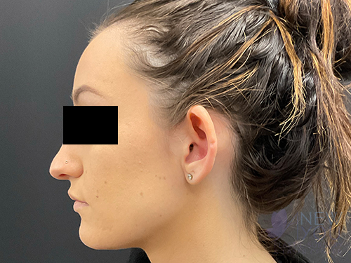 Ear Reshaping (Otoplasty) Before - Chicago, IL