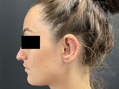 Ear Reshaping (Otoplasty) After - Chicago, IL