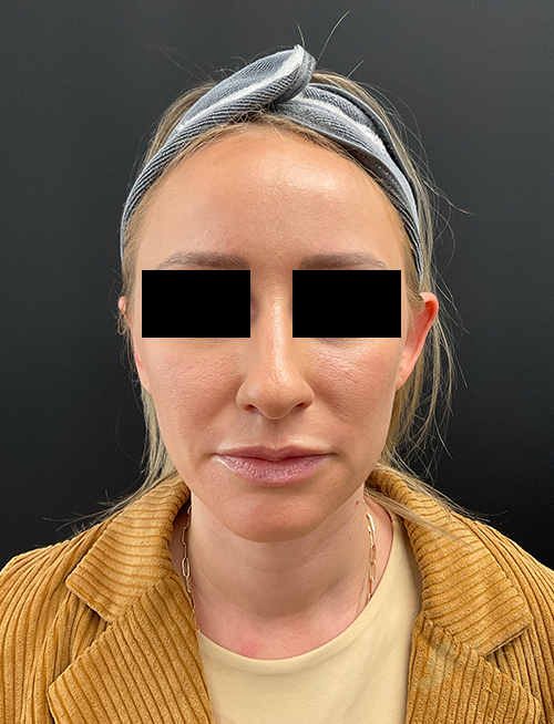Ear Reshaping (Otoplasty) Before Ear Reshaping (Otoplasty) Before - Chicago, IL