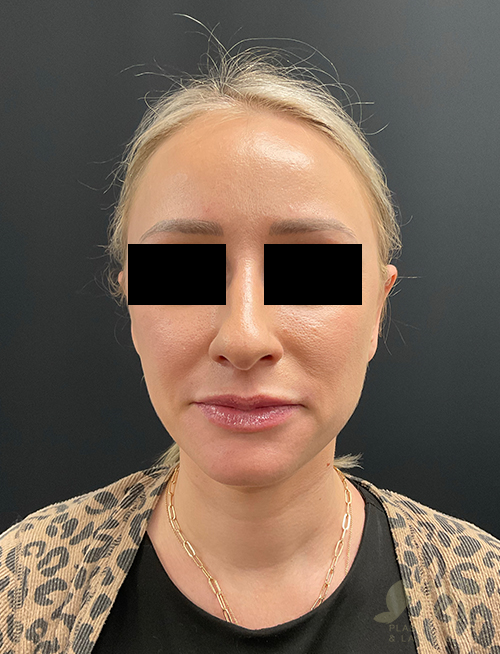 Ear Reshaping (Otoplasty) After Ear Reshaping (Otoplasty) After - Chicago, IL