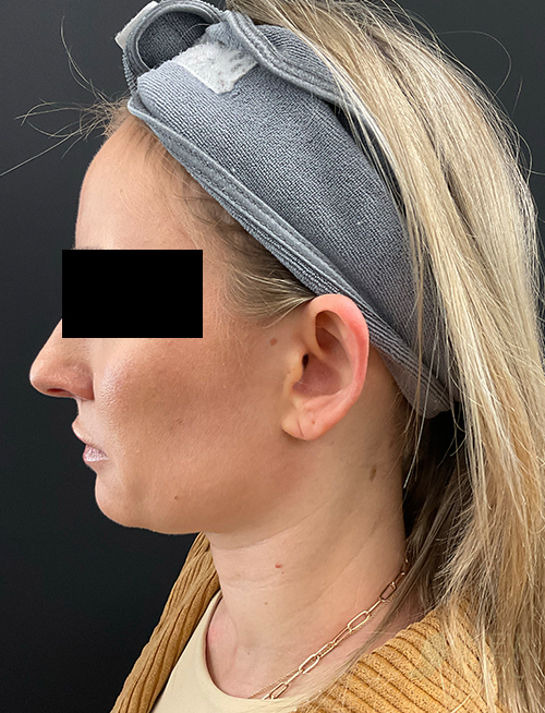 Ear Reshaping (Otoplasty) Before Ear Reshaping (Otoplasty) Before - Chicago, IL