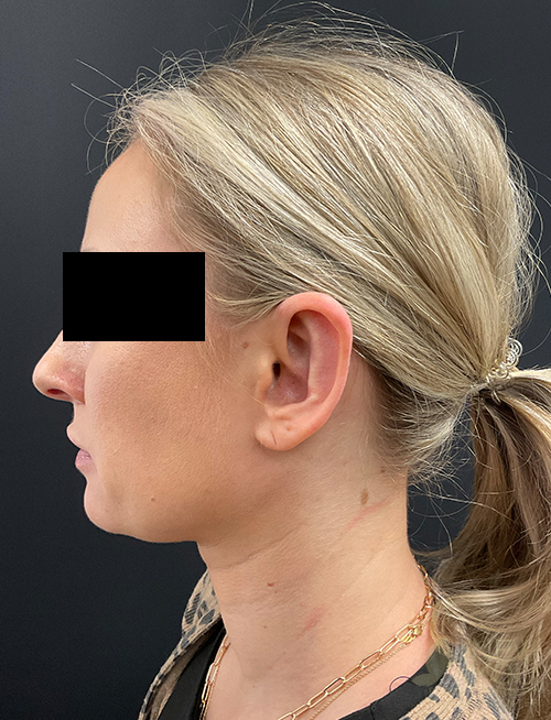 Ear Reshaping (Otoplasty) After Ear Reshaping (Otoplasty) After - Chicago, IL