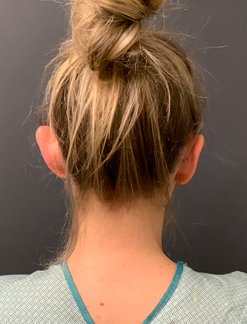 Ear Reshaping (Otoplasty) Before Ear Reshaping (Otoplasty) Before - Chicago, IL