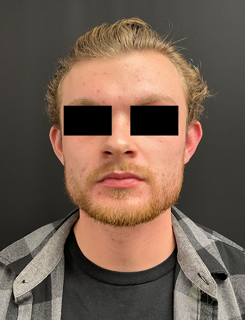 Ear Reshaping (Otoplasty) Before Ear Reshaping (Otoplasty) Before - Chicago, IL