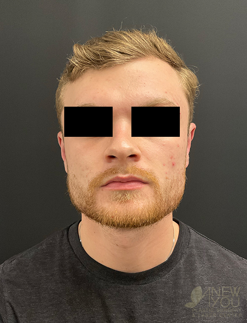 Ear Reshaping (Otoplasty) After Ear Reshaping (Otoplasty) After - Chicago, IL