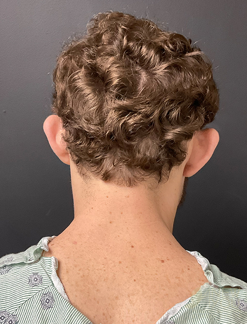 Ear Reshaping (Otoplasty) Before Ear Reshaping (Otoplasty) Before - Chicago, IL