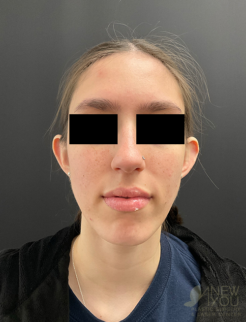 Ear Reshaping (Otoplasty) Before Ear Reshaping (Otoplasty) Before - Chicago, IL