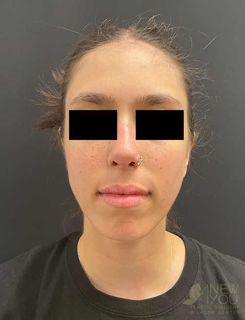 Ear Reshaping (Otoplasty) After Ear Reshaping (Otoplasty) After - Chicago, IL