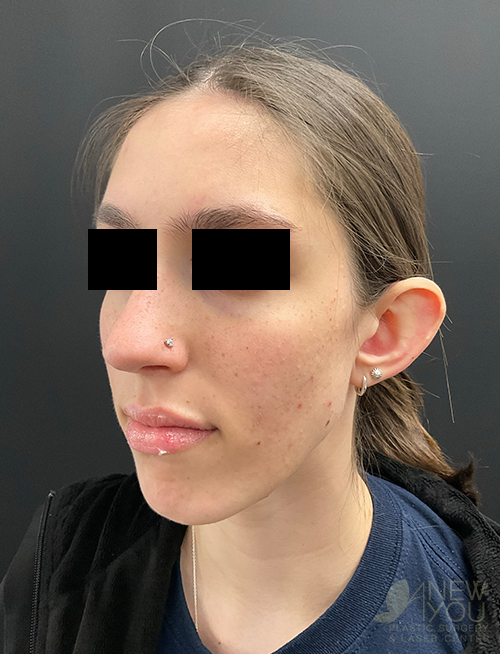 Ear Reshaping (Otoplasty) Before Ear Reshaping (Otoplasty) Before - Chicago, IL