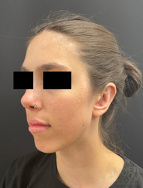 Ear Reshaping (Otoplasty) After Ear Reshaping (Otoplasty) After - Chicago, IL