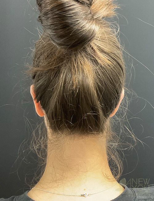 Ear Reshaping (Otoplasty) After Ear Reshaping (Otoplasty) After - Chicago, IL