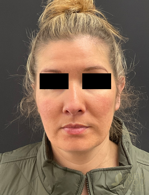 Ear Reshaping (Otoplasty) After Ear Reshaping (Otoplasty) After - Chicago, IL