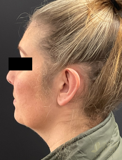 Ear Reshaping (Otoplasty) After - Chicago, IL