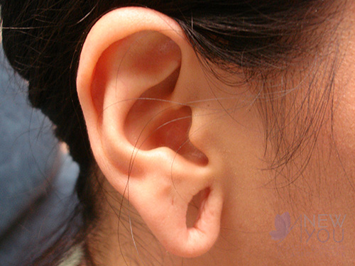 Ear Reshaping (Otoplasty) Before Earlobe Repair Before - Chicago, IL