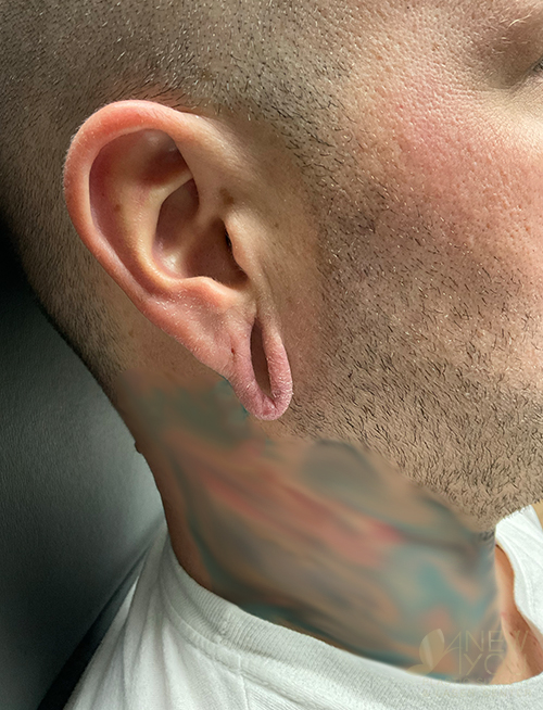 Ear Reshaping (Otoplasty) Before Earlobe Repair Before - Chicago, IL