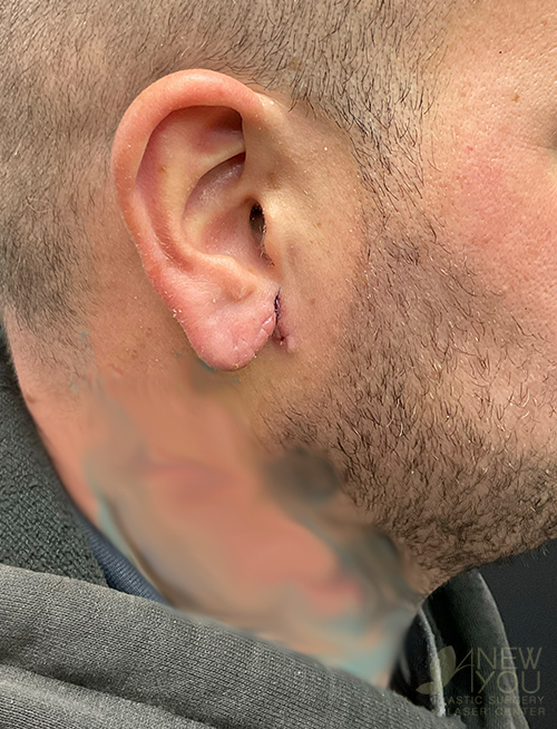 Earlobe Reapair After - Chicago, IL