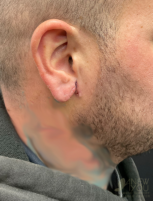 Earlobe Repair After Earlobe Reapair After - Chicago, IL