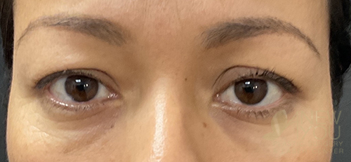 Eyelid Lift Before - Chicago, IL
