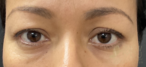 Eyelid Lift Before Eyelid Lift Before - Chicago, IL