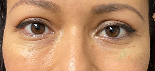 Eyelid Lift After Eyelid Lift After - Chicago, IL