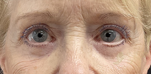 Eyelid Lift After Eyelid Lift After - Chicago, IL