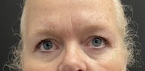 Eyelid Lift Before Eyelid Lift Before - Chicago, IL
