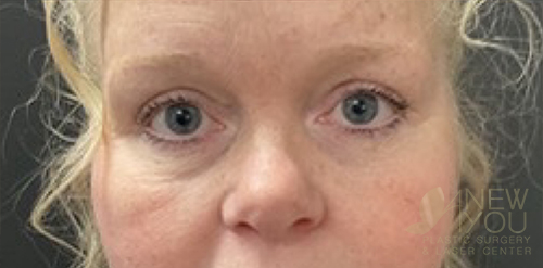 Eyelid Lift After Eyelid Lift After - Chicago, IL