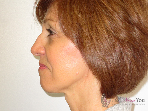 Female Facelift After - Chicago, IL