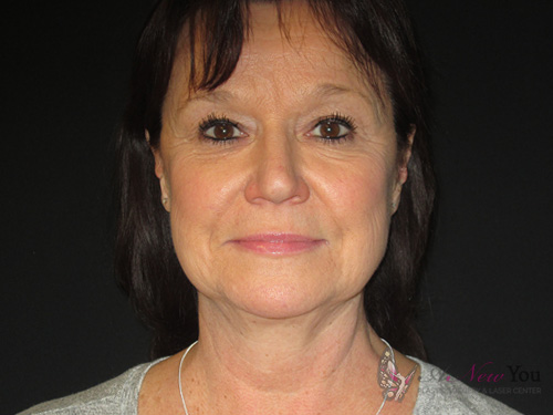 Female Facelift Before Female Facelift Before - Chicago, IL